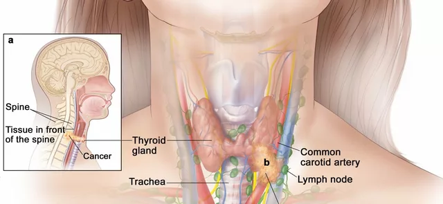 Thyroid Cancer in Children: Causes, Symptoms, and Treatment